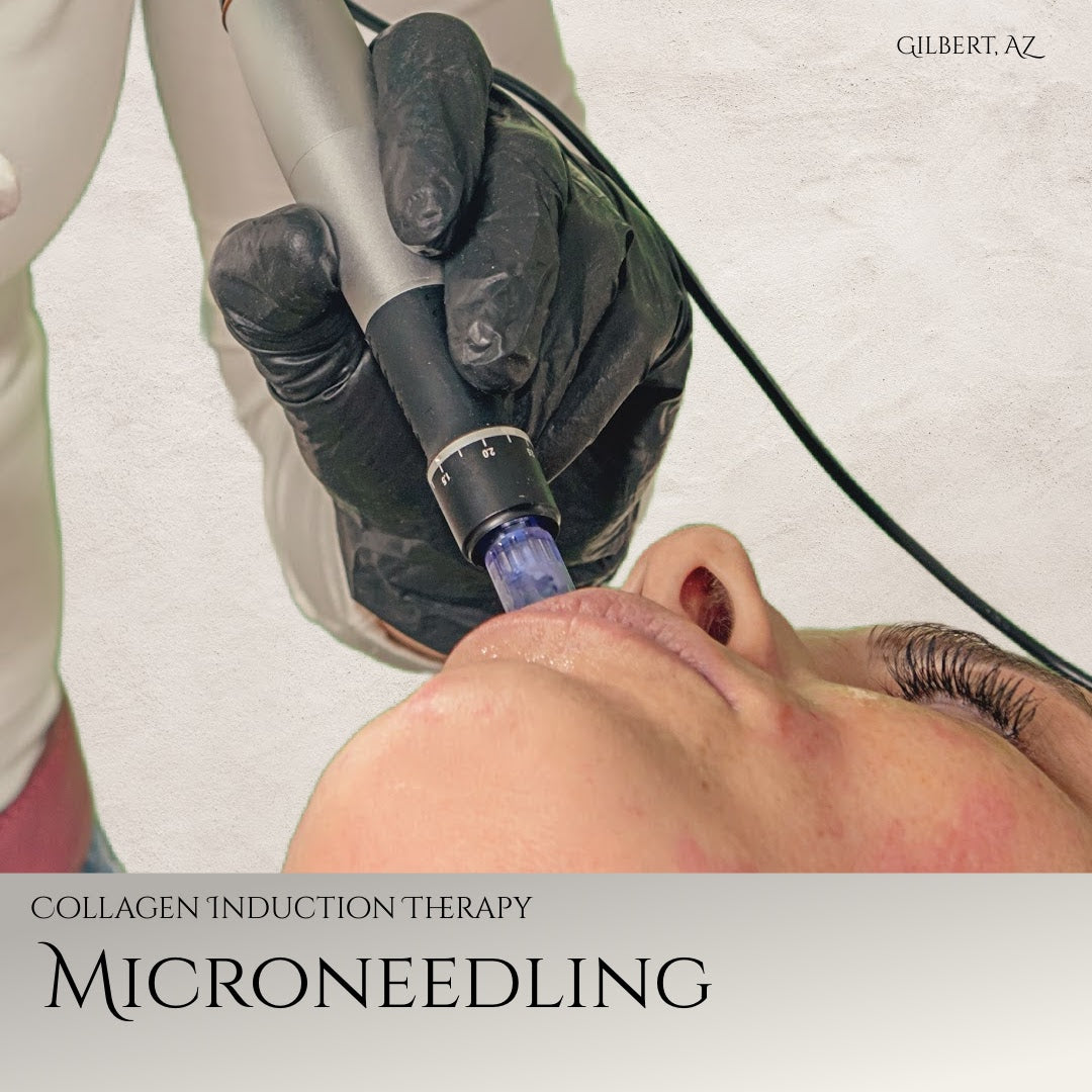Microneedling Facial at Gilbert, AZ