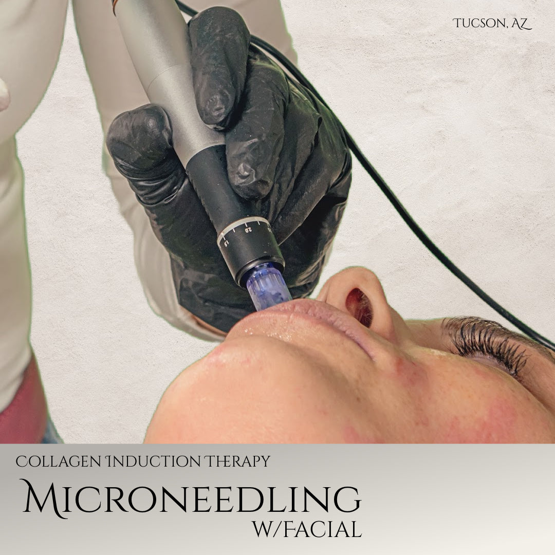 Microneedling Facial at Tucson, AZ
